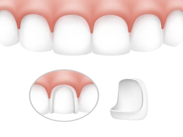 How do veneers work in a smile makeover?